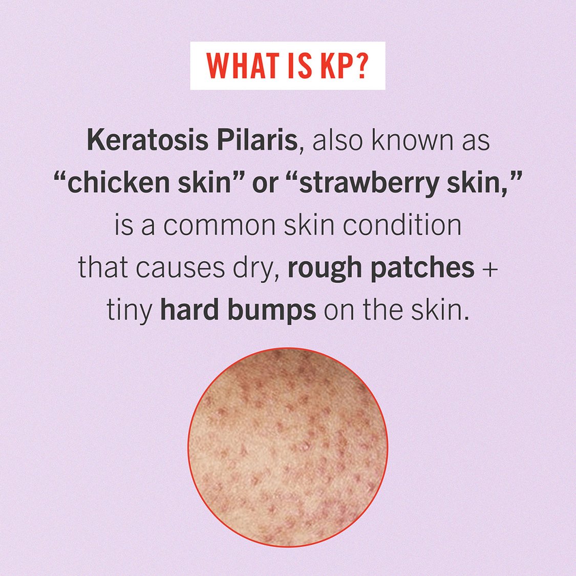 FIRST AID BEAUTY KP Bump Eraser Body Scrub - 56.7g